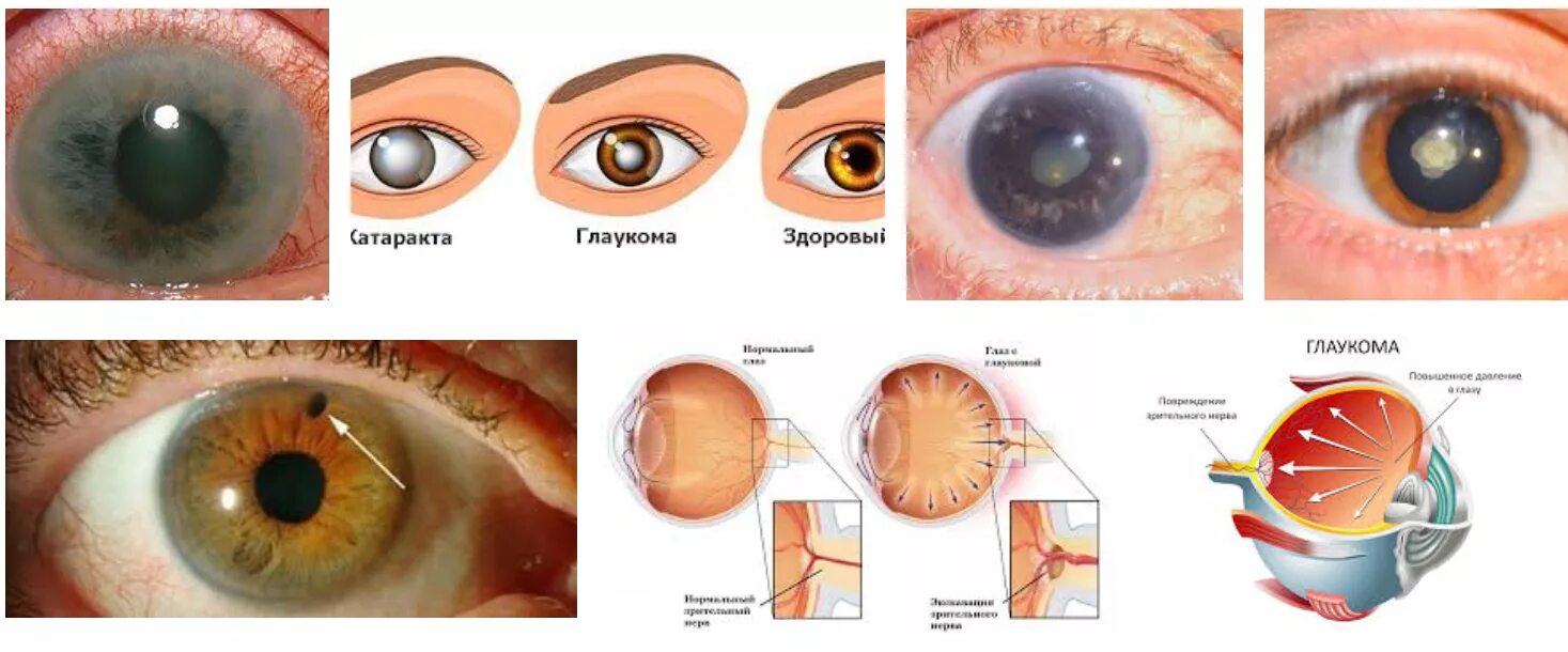Как вылечить глаукому. Ретинопатия катаракта глаукома. Закрытоугольная глаукома глаза. Глаз при остром приступе глаукомы.