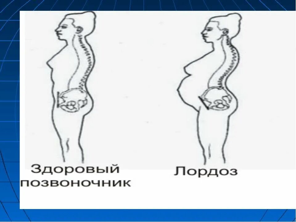 Лордоз и беременность. Лордоз позвоночника. Лордоз поясничного отдела позвоночника. Лордоз и кифоз позвоночника. Щенок по имени лордоз