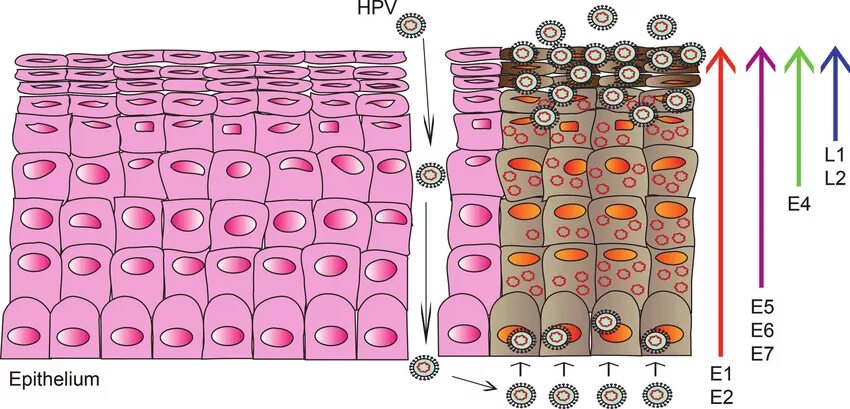 Hpv 2. Hpv 2. Hpv 2. Папиллома под микроскопом. Кондилома бушке левенштейна.