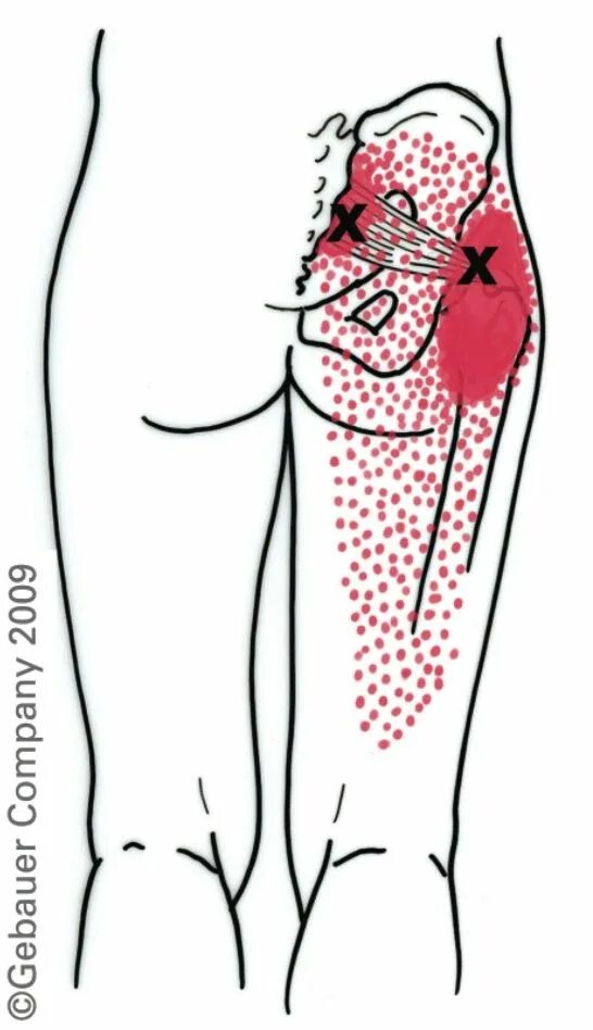Почему после уколов болит ягодица. Точка выхода седалищного нерва схема. Триггерные точки седалищного нерва. Триггерные точки грушевидной мышцы. -Воспаление седалищного нерва Акупрессура.