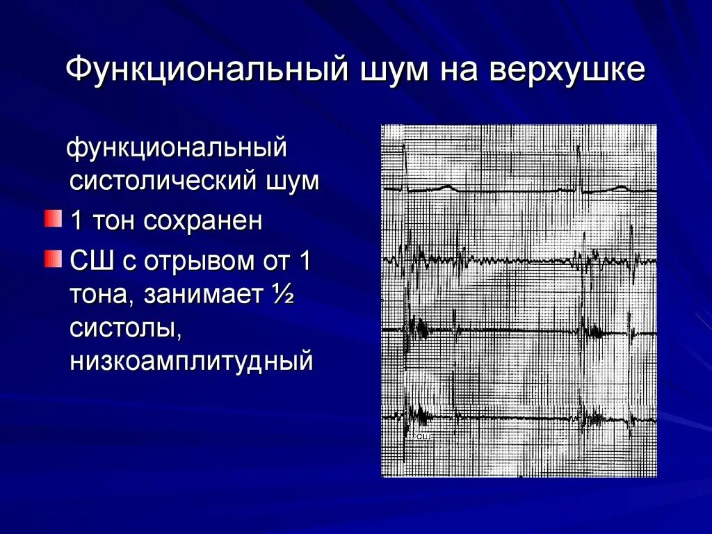 Систолический шум на ФКГ. Пороки сердца с систолическим шумом. Функциональный систолический шум. Систолический шум на верхушке. Систолический шум это