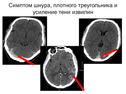 Венозный инсульт