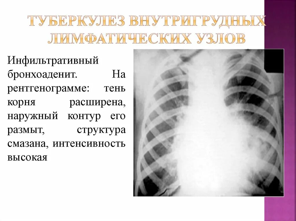 Бронхоаденит это. Инфильтративный туберкулез рентгенография. туберкулез внутригрудных лимфоузлов рентгенограмма. твглу туберкулез рентгенограмма. бронхоаденит форма туберкулеза.