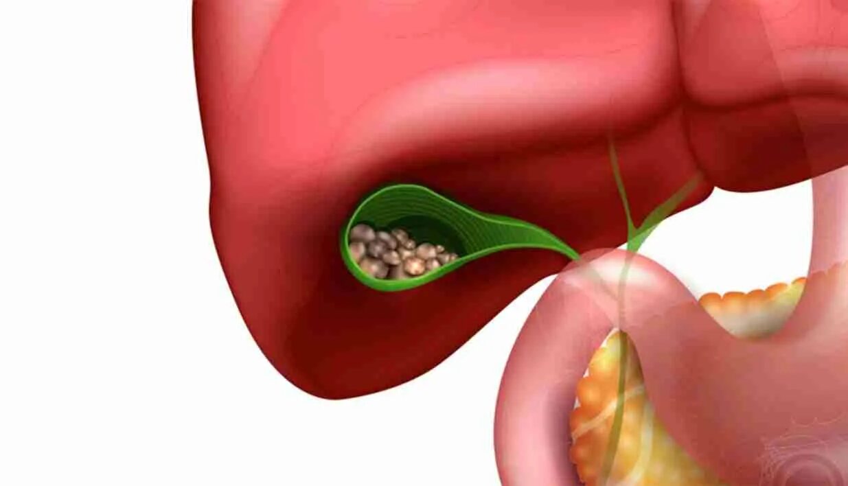 Удален желчный пузырь симптомы. Желчекаменная болезнь. Желчнокаменная болезнь (холелитиаз). ЖКБ камни желчного пузыря.
