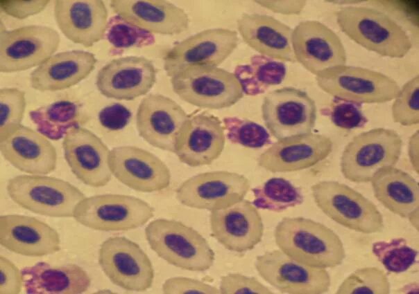 Кариопикноз это. Кариопикноз и кариолизис под микроскопом. Кариорексис цветок.