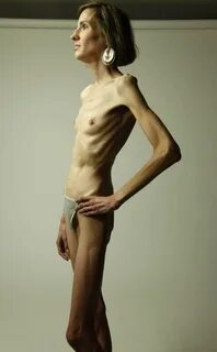 Anorexic nude women ✔ Фото Женщин Худых 50 Голых.