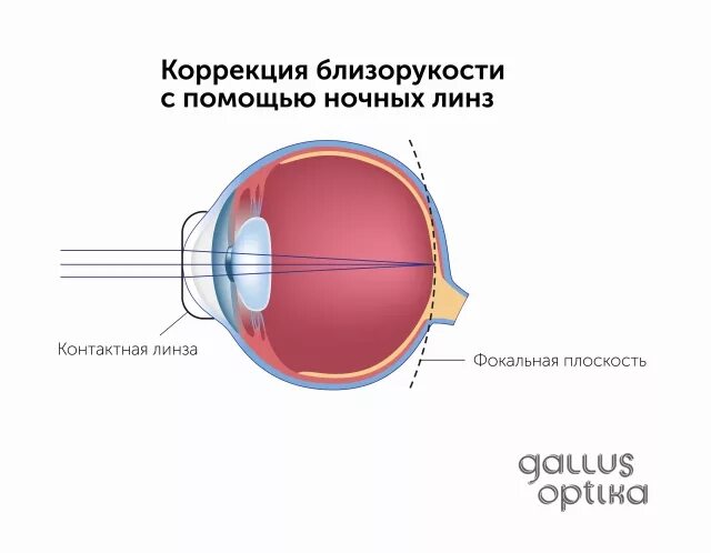 Коррекция зрения с помощью линз. Линзы для коррекции миопии. Линзы для коррекции миопии (близорукости). Нормальное зрение. Линзы на очки для коррекции миопии.