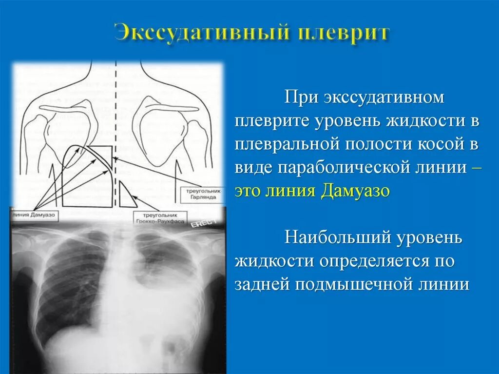 Положение при плеврите