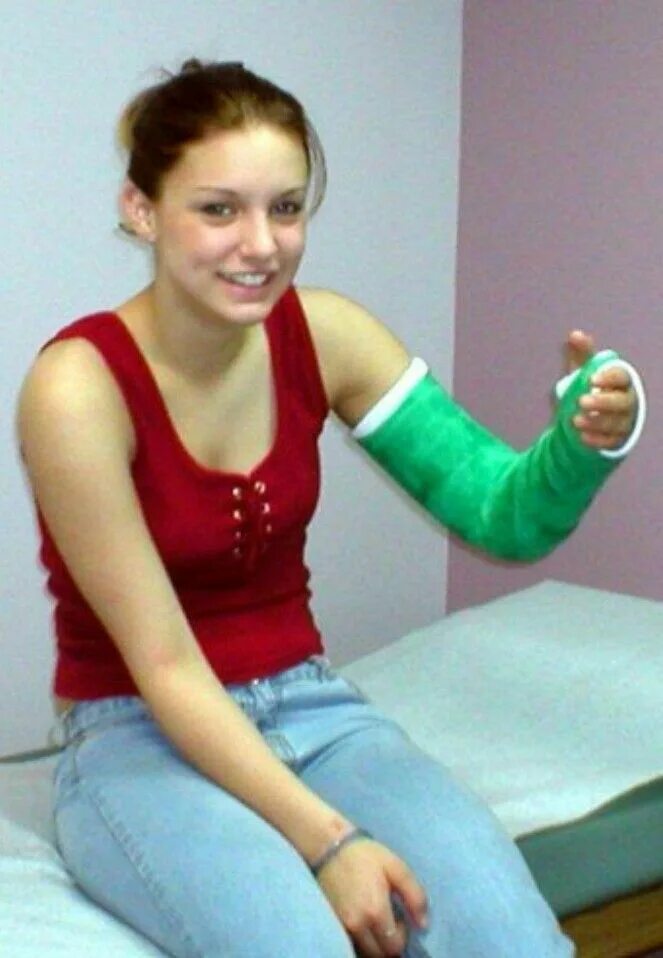 Arm casting. Arm cast lac women. gipsverband.