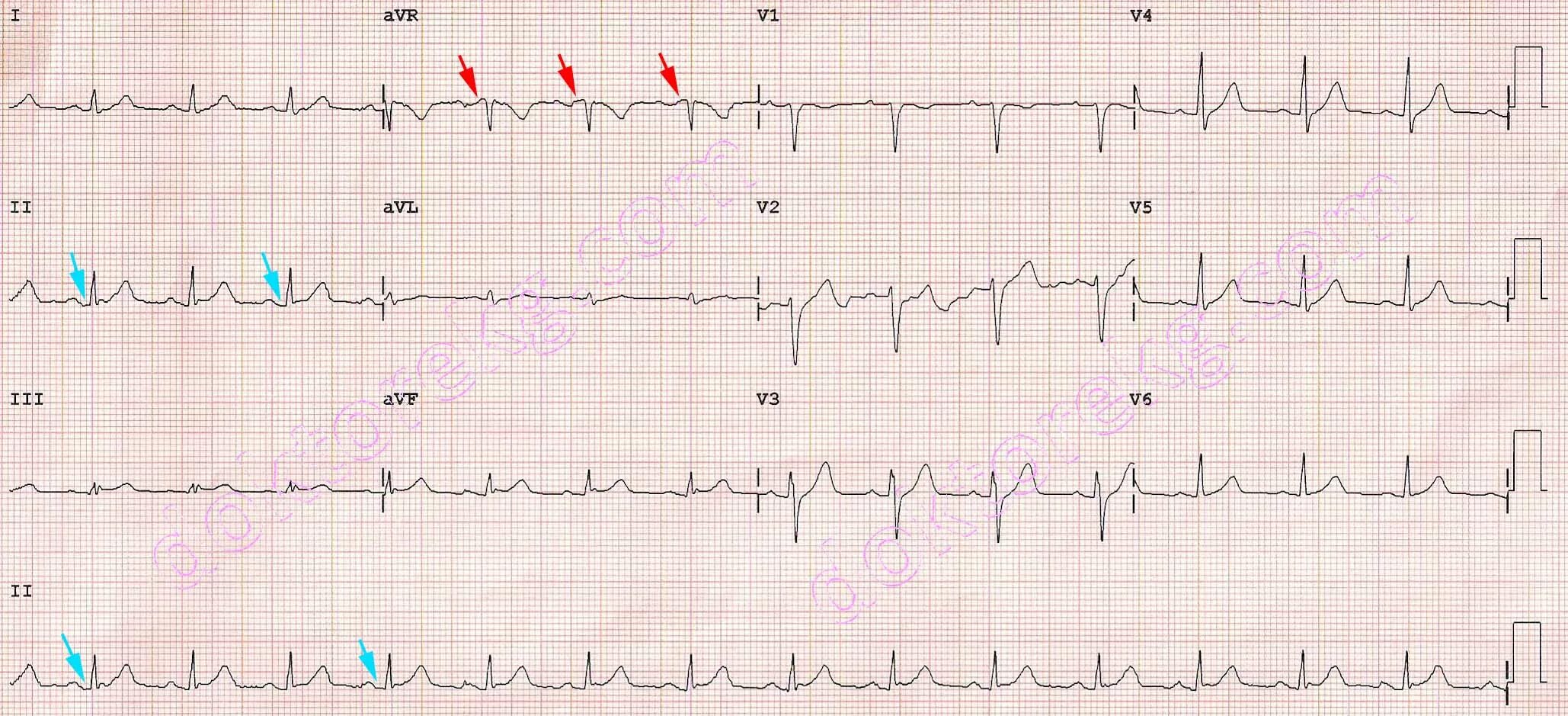 Кардиограмма рядом со мной. Кардиограмма рядом со мной. Пульсация сердца. Кардиограмма сердца. Сердцебиение без фона.