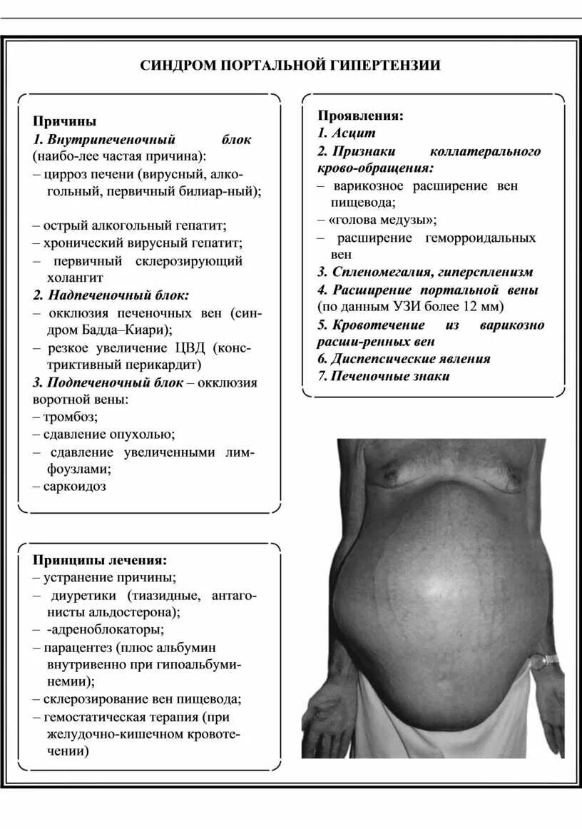 Асцит при раке яичников. Проявления синдрома портальной гипертензии. синдром портальной гипертензии гиперспленизм. портальная гипертензия асцит. асцит, гепатолиенальный синдром. синдром портальной гипертензии.