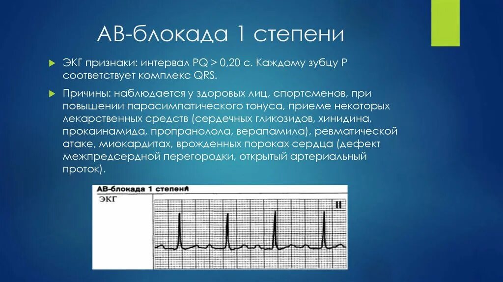 Атриовентрикулярная блокада 2. Атриовентрикулярная блокада Мобиц 1 ЭКГ. Са-блокада II степени, Тип 2 (Мобитц 2). Атриовентрикулярная блокада 2 степени Мобитц 2 на ЭКГ. АВ блокады 2 степени Мобиц 2 на ЭКГ.