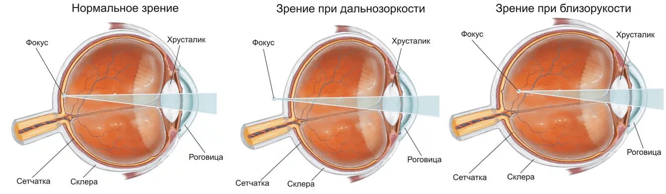 Улучшение зрения дальнозоркость