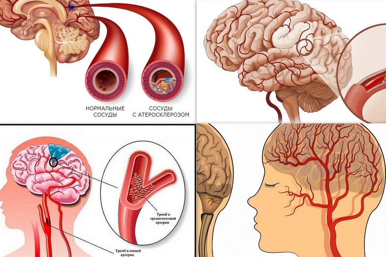 Инсульт органа. Атеросклероз артерий головного мозга. Проявления атеросклероза артерий головного мозга. Атеросклеротическое поражение сосудов головного мозга. Атеросклеротические поражения артерий головного мозга.