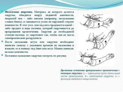Наложение давящего жгута
