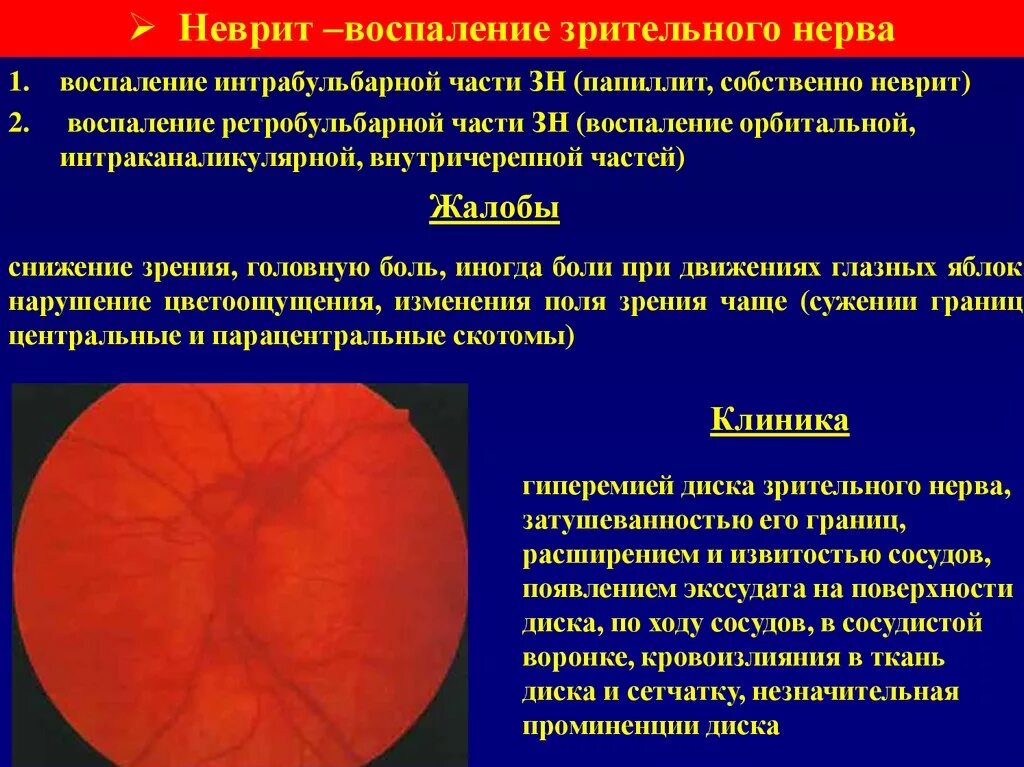 Оптический неврит папиллит. Неврит зрительного нерва классификация. Ретробульбарный неврит (папиллит).