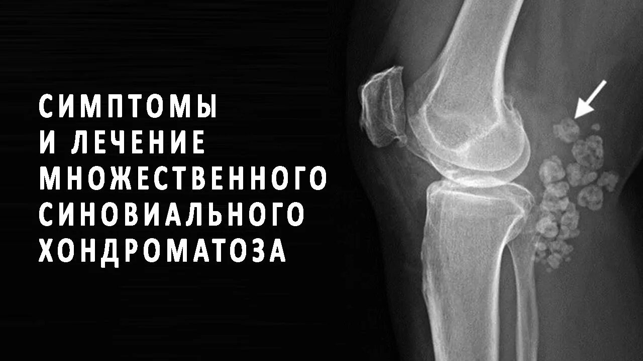 Хондроматоз коленного сустава рентген. Хондромные тела в коленном суставе. Синовиальный хондроматоз коленного сустава рентген. Хондроматоз тазобедренного сустава рентген. Синовиальный хондроматоз рентген.