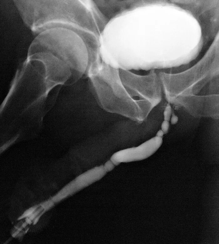 Стриктура уретры рентген. Ретроградная уретрография. Микционная цистография дивертикул. Ретроградная уретрография стриктура.