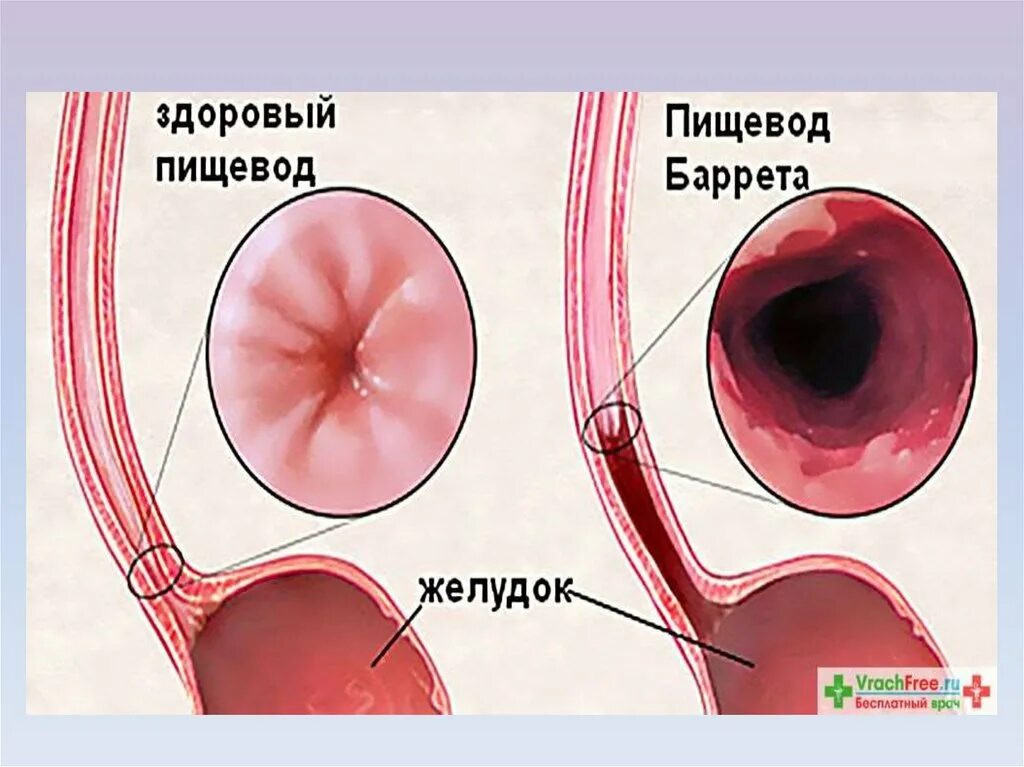 Пищевод Барретта классификация. Пищевод Барретта этиология. Пищевод Барретта эндоскопия.