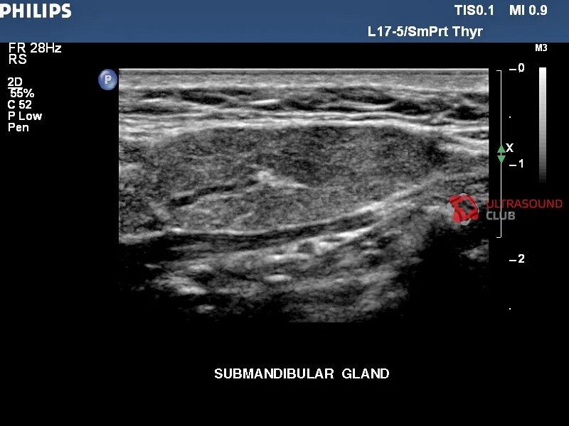 Плеоморфная аденома околоушной железы УЗИ. Подчелюстная слюнная железа на УЗИ норма. УЗИ околоушной железы протокол. УЗИ подчелюстной слюнной железы протокол. Узи околоушной железы