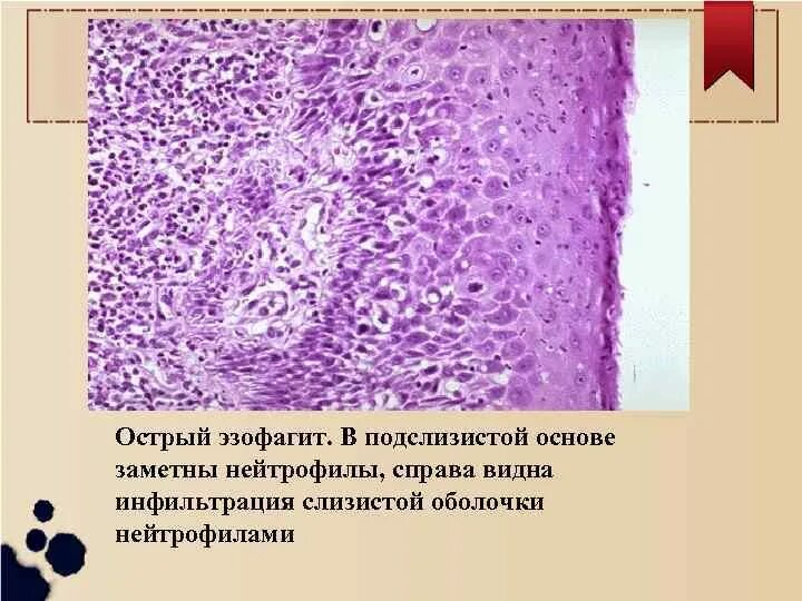 Эрозивный эзофагит гистология. Эрозивный эзофагит микропрепарат. Эзофагит препараты патанатомия. Острый эзофагит морфологические изменения. Биоптат слизистой оболочки