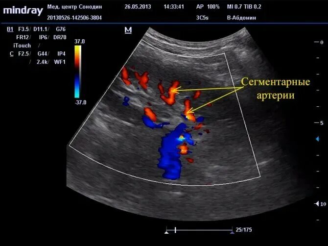 Доплер почек. УЗИ почек допплер сосудов почек. Доплер УЗИ сосудов почек. Доплер сосудов кровотока почек. УЗИ сосудов почки допплер.