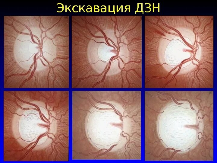 Зрительный нерв при глаукоме. Глаукомная экскавация ДЗН. Глаукомная атрофия зрительного нерва. Глаукома диск зрительного нерва.