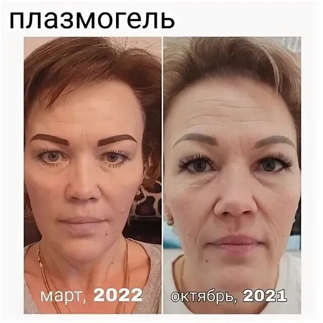 Плазмогель для лица отзывы. Плазмогель для лица отзывы. Плазмогель для лица отзывы. Плазмотерапия лица до и после. Плазмогель для лица отзывы.