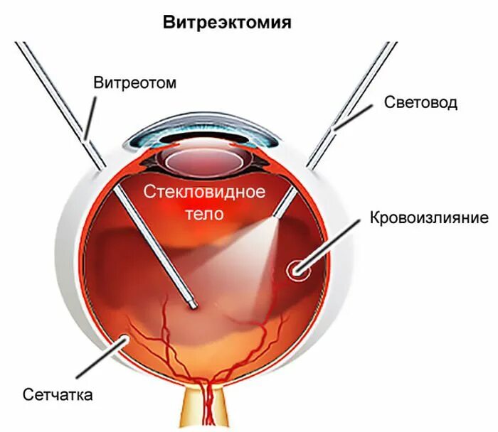 Отслойка сетчатки витрэктомия. Витрэктомия при диабетической ретинопатии. Витрэктомия задняя субтотальная закрытая. Витрэктомия глаза ход операции.