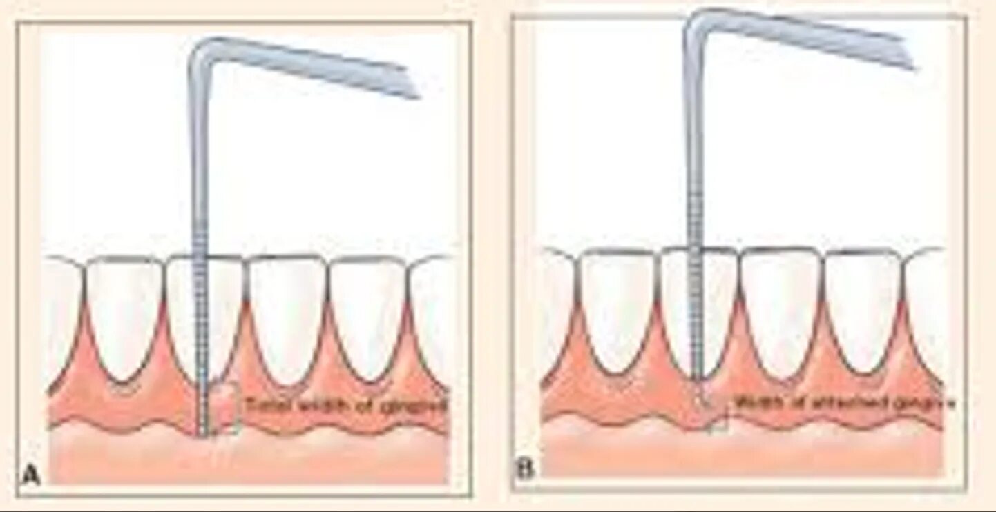 Кератинизированная Десна в норме. Ширина кератинизированной десны. Прикрепленная Десна и кератинизированной. Кератизировагая Десна. Прикрепленная десна