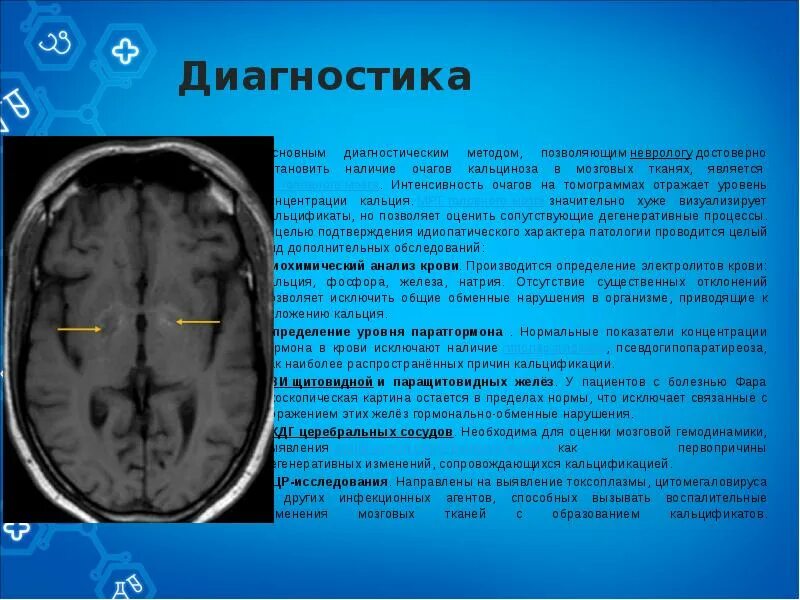 Неспецифические изменения головного мозга. Ирритативные изменения головного мозга. Интенсивность очага кт. Кальций отложился в головном мозге. Цитомегаловирус мрт головного мозга.