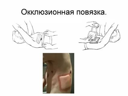При наложении повязки при открытом пневмотораксе необходимо