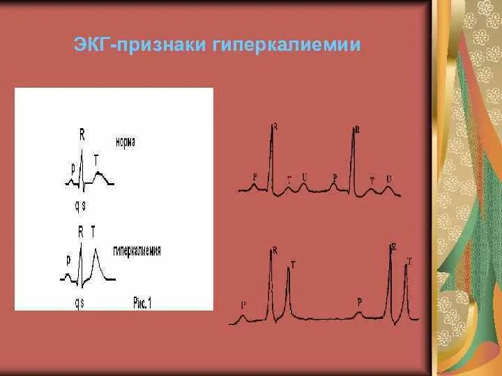 Гиперкалиемия признаки симптомы. Зубец т на экг при гиперкалиемии. высокий зубец т при гиперкалиемии. гиперкалиемия экг картина.