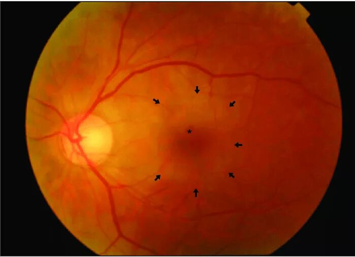 Макулярный отек лечение. Макулярная отслойка сетчатки. Экссудативная отслойка сетчатки. Кистовидный макулярный отек сетчатки.
