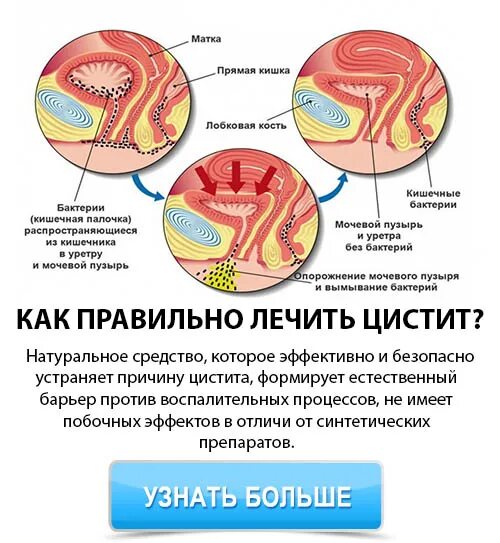 Воспаление мочевого пузыря у женщин лечение. Посткоитальный цистит терапия. цистит у женщин. причины цистита у женщин. цистит у женщин симптомы.