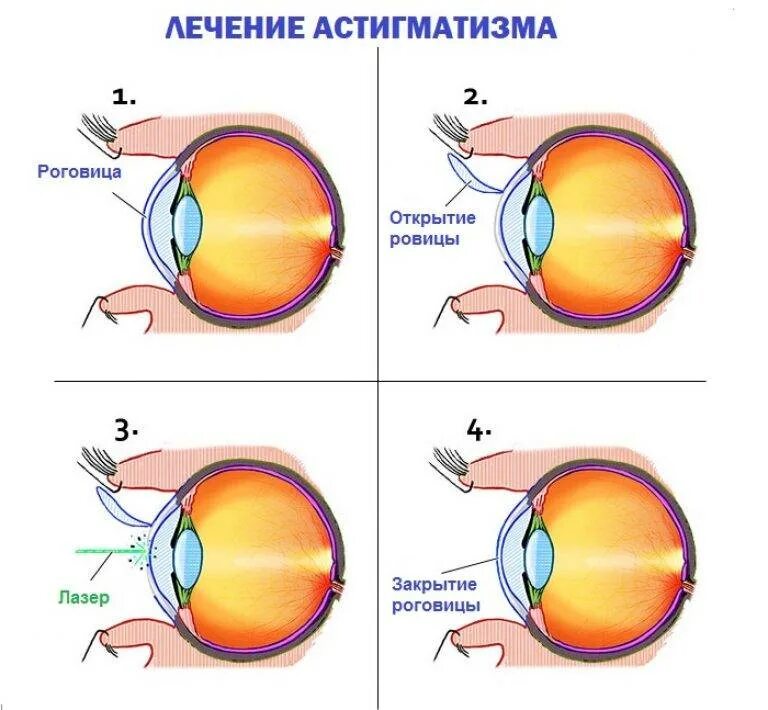 Гиперметропический астигматизм у детей. Миопический роговичный астигматизм. Гиперметропия 1 степени миопический астигматизм. Строение глаза астигматизм.