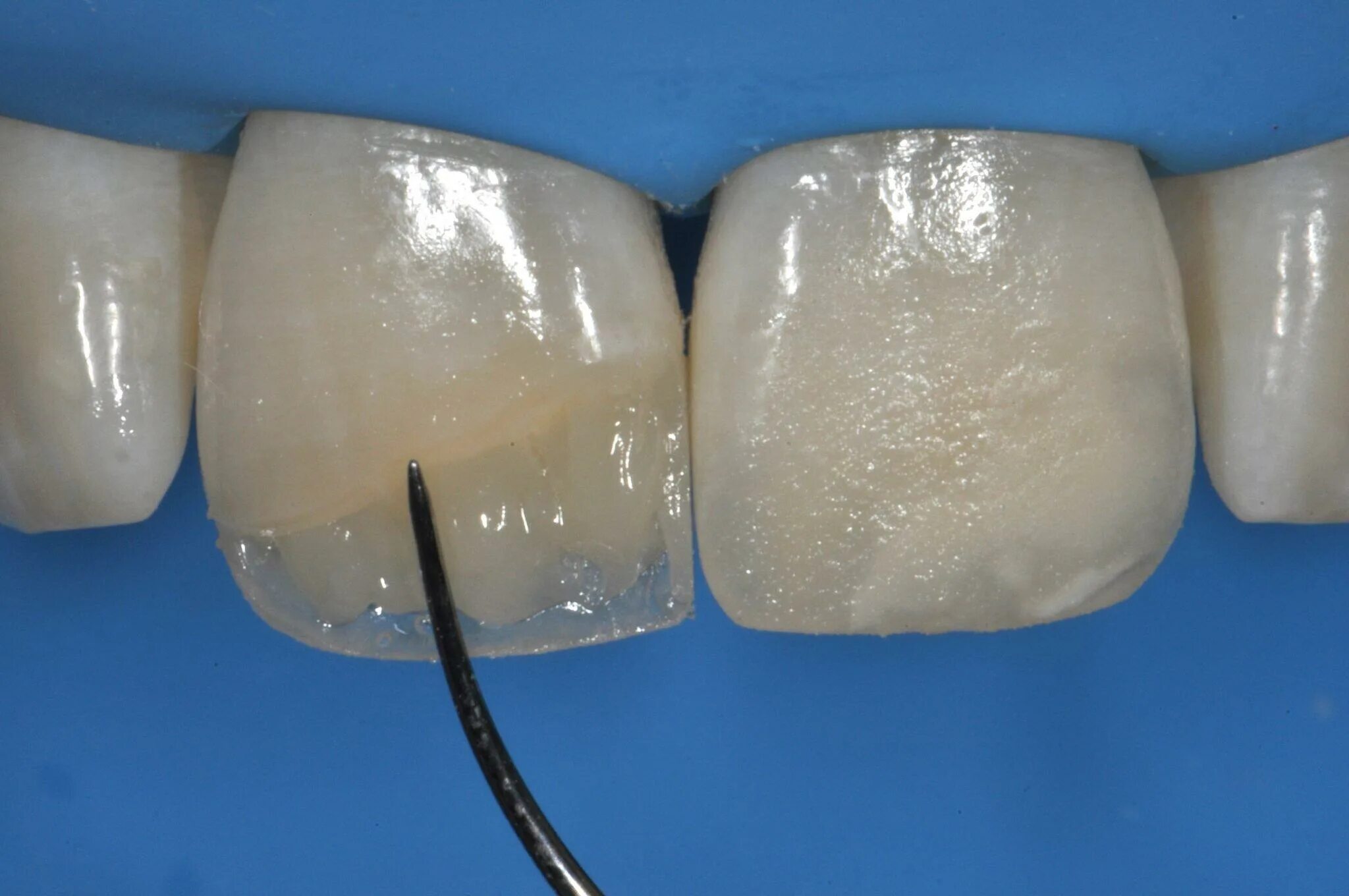 Материал для реставрации зубов. Композитные виниры кариес. Композитная коронка на зуб. Восстановление фронтальных зубов.