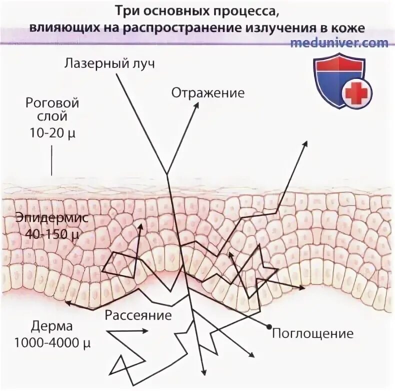 Лазерное воздействие на кожу skinlift ru. Воздействие лазера на кожу. Воздействие лазерного излучения на кожу. Влияние лазера на кожу человека. Воздействие лазера на ткани.