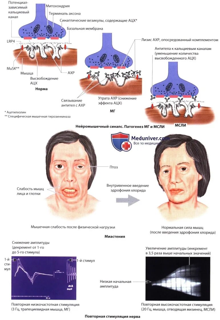 Миастенический синдром Ламберта-Итона симптомы. Миастения и миастенический синдром. Миастения Ламберта Итона. Синдром Ламберта Итона патогенез. Миопатия глаза что это