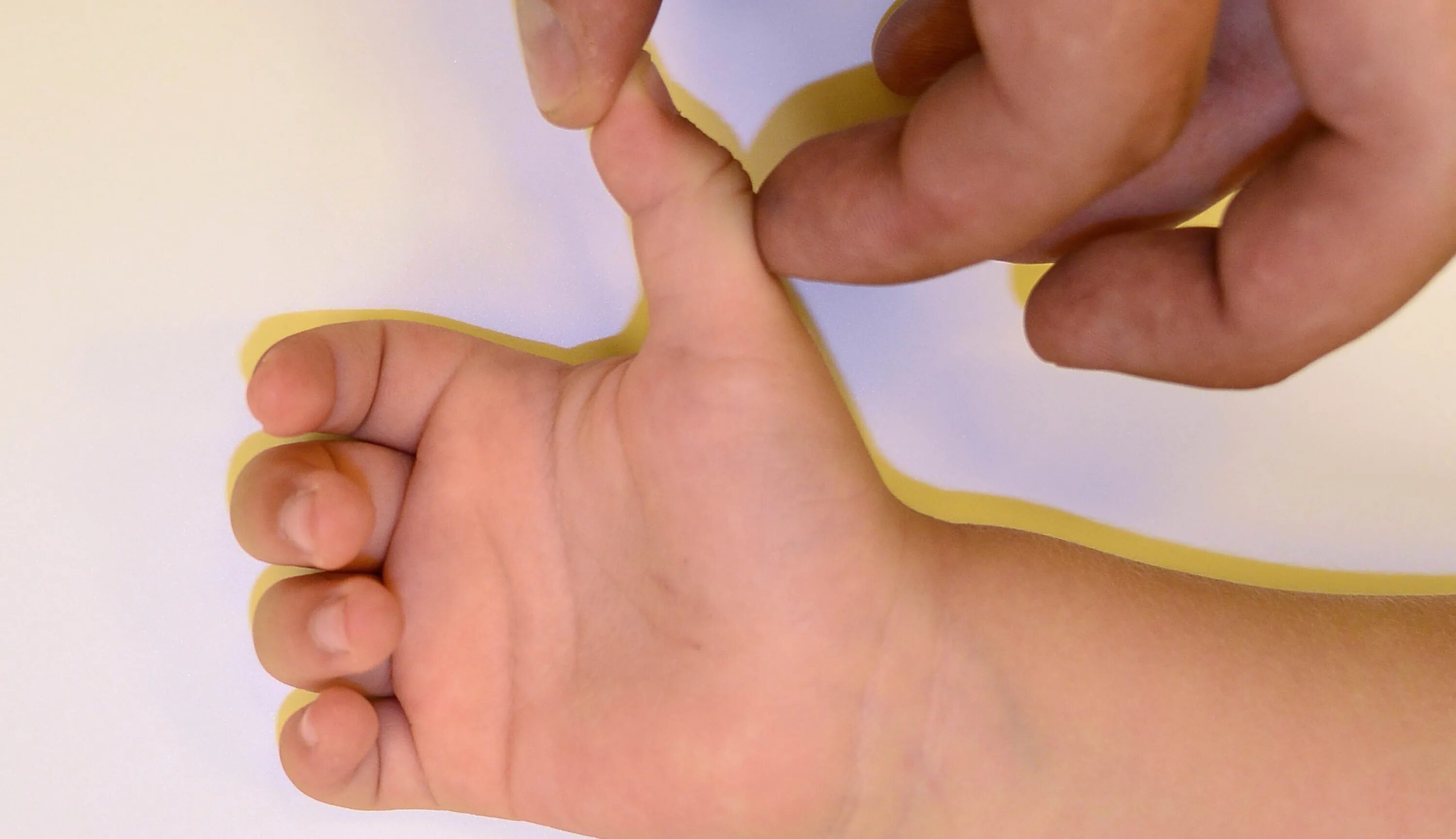 Показания к хирургическому. Болезнь нотта большого пальца кисти. Болезнь нотте у взрослых. Стенозирующий лигаментит 1. Стенозирующий лигаментит пальца.