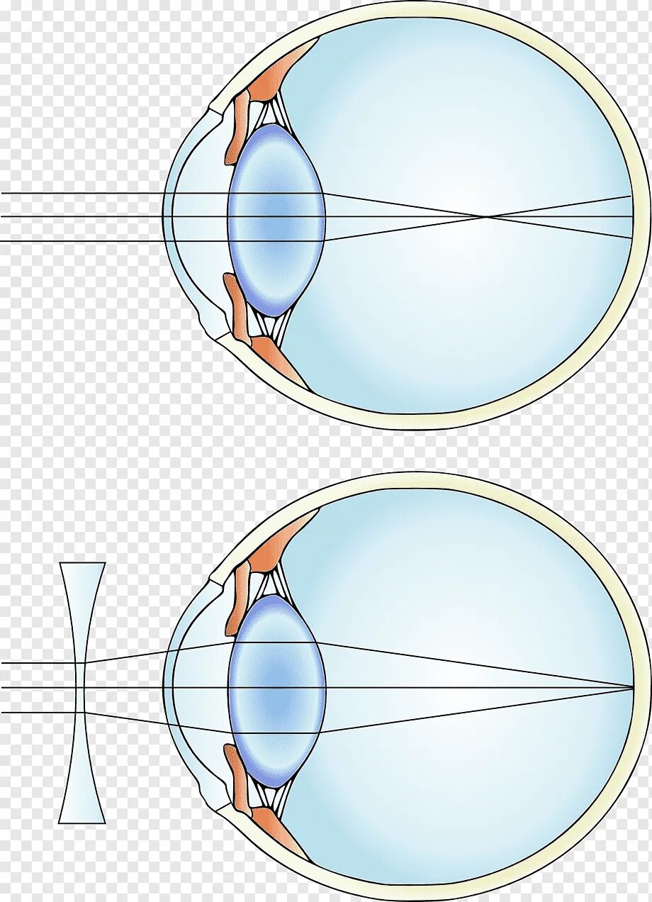 Фокусировка лучей света на внутренней поверхности. Миопия дальнозоркость астигматизм. Миопия двояковогнутые линзы. Близорукость и дальнозоркость сетчатка. Двояковогнутая линза для близорукости.