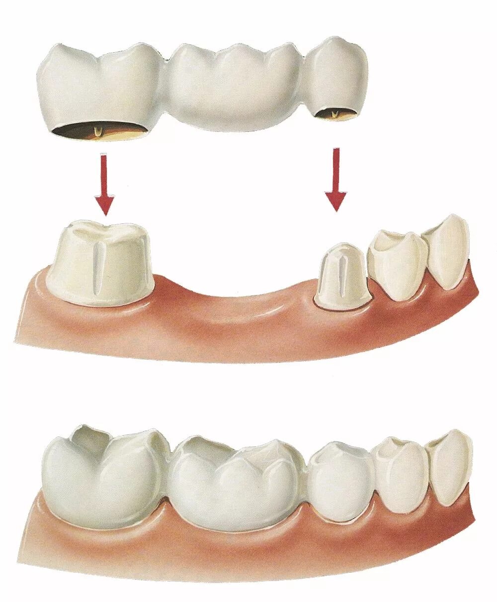 Через сколько можно вставить зубы. Мостовидные протезы классификация. Зубной мост мостовидный протез. Консольный мостовидный протез. Мостовидный зубной несъемный протез.