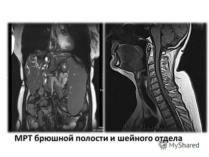 Мрт брюшная полость где