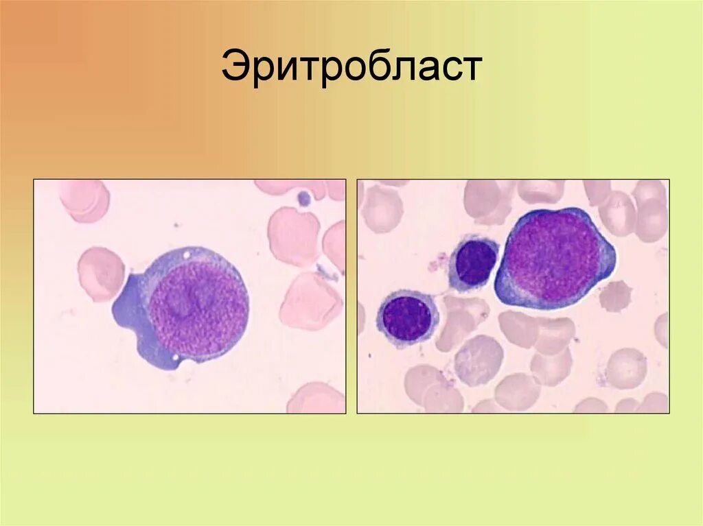 Эритробласт. Базофильный нормобласт. проэритробласт базофильный эритробласт. базофильный полихроматофильный и оксифильный эритробласт. оксифильные нормобласты.