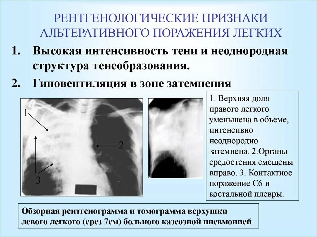 Тени в верхней доле легкого. Гиповентиляция верхней доли рентген. Интенсивность тени на рентгенограмме. Гиповентиляция правого легкого. Гиповентиляция на рентгенограмме.