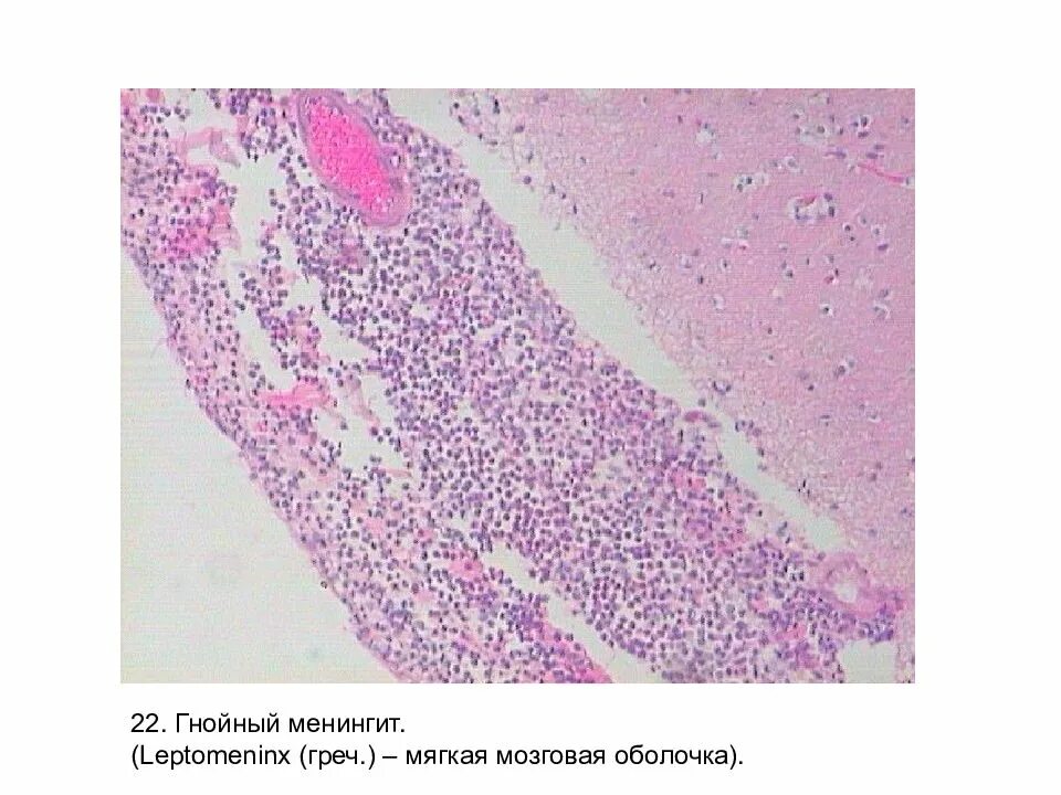 Гнойный менингит препарат патанатомия. Гнойный менингит микропрепарат патанатомия. Гнойный менингоэнцефалит гистология. Гнойный менингит гистопрепарат.