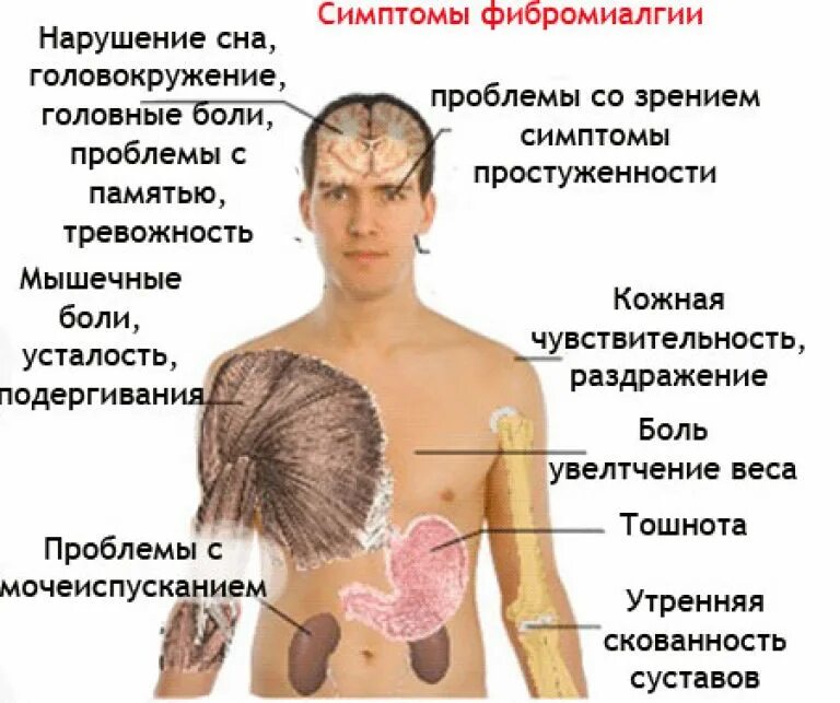 Фибромиалгия симптомы. Фибромиалгия. синдром фибромиалгии. фибромиалгия симптомы симптомы. заболевание мышц фибромиалгия.