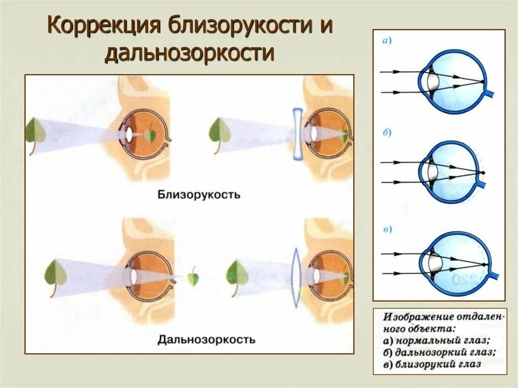 Фокусировка глаза человека. Схема глаза при близорукости и дальнозоркости. Миопия схема глаза. Схема глаза человека при близорукости. Глаз при миопии схема.