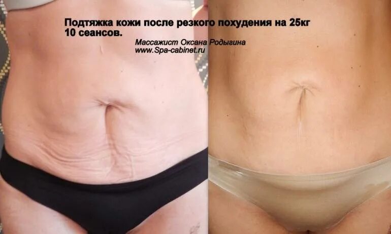 Подтяжка кожи после похудения. Подтянуть кожу после похудения. подтянуть обвисшую кожу на животе.