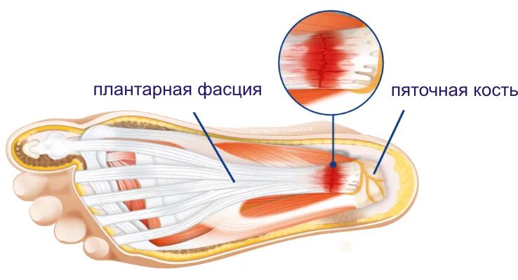 Фасциит стопы. Плантарный фасциит стопы. Плантарный апоневроз стопы. Плантарный фасциит мкб.